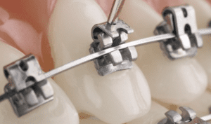 What Are the Different Types of Braces?